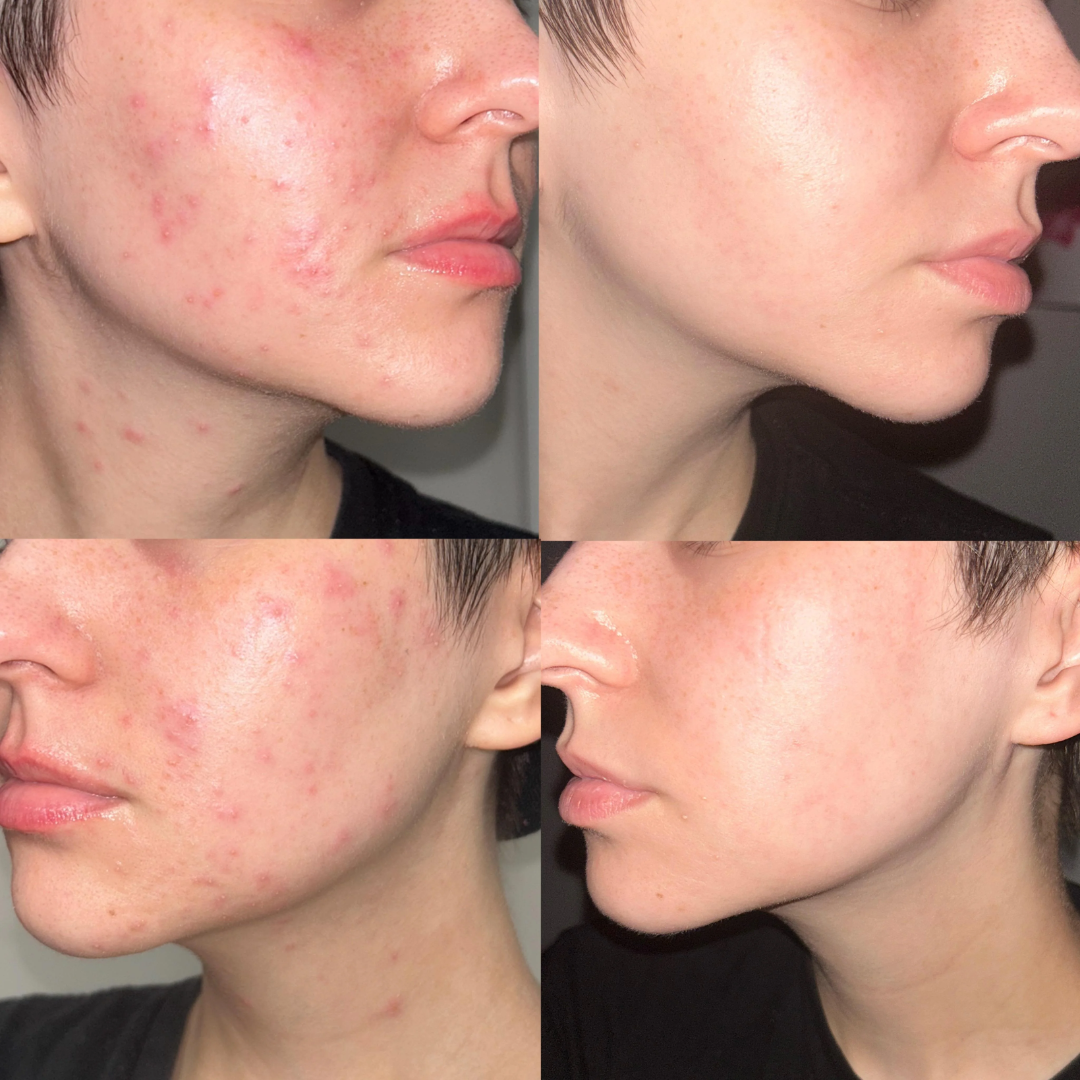 Acne & Acne Scars Removal Cream | Salicylic Acid + Niacinamide + Hyaluronic Acid + Tea Tree |
