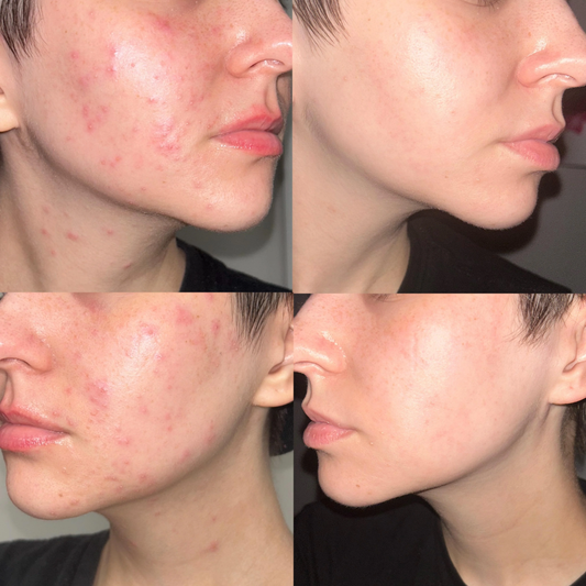 Acne & Acne Scars Removal Cream | Salicylic Acid + Niacinamide + Hyaluronic Acid + Tea Tree | Reduces Breakouts, Fades Scars & Evens Skin Tone