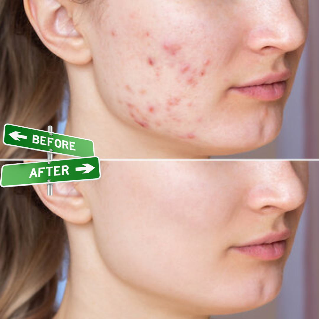 Acne & Acne Scars Removal Cream | Salicylic Acid + Niacinamide + Hyaluronic Acid + Tea Tree |