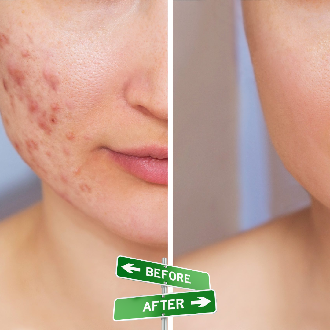 Acne & Acne Scars Removal Cream | Salicylic Acid + Niacinamide + Hyaluronic Acid + Tea Tree |