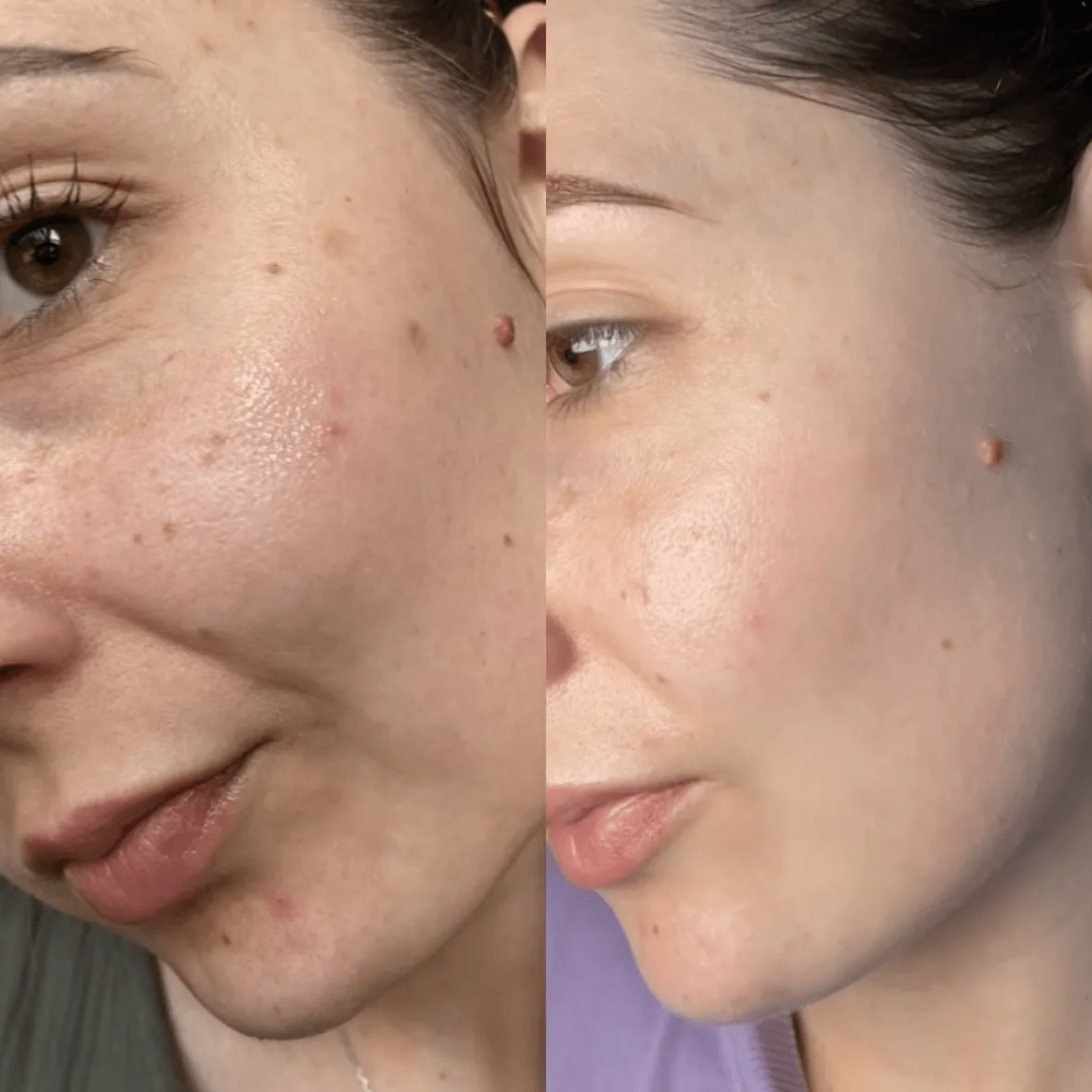 Teashell Niacinamide Brightening Serum | Fade Dark Spots, Acne Marks & Even Skin Tone